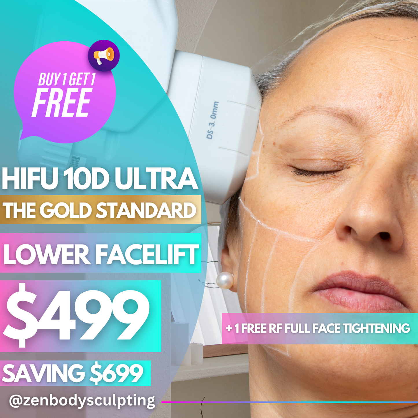 HIFU 10D ULTRA - 2 SESSIONS OF LOWER FACELIFT