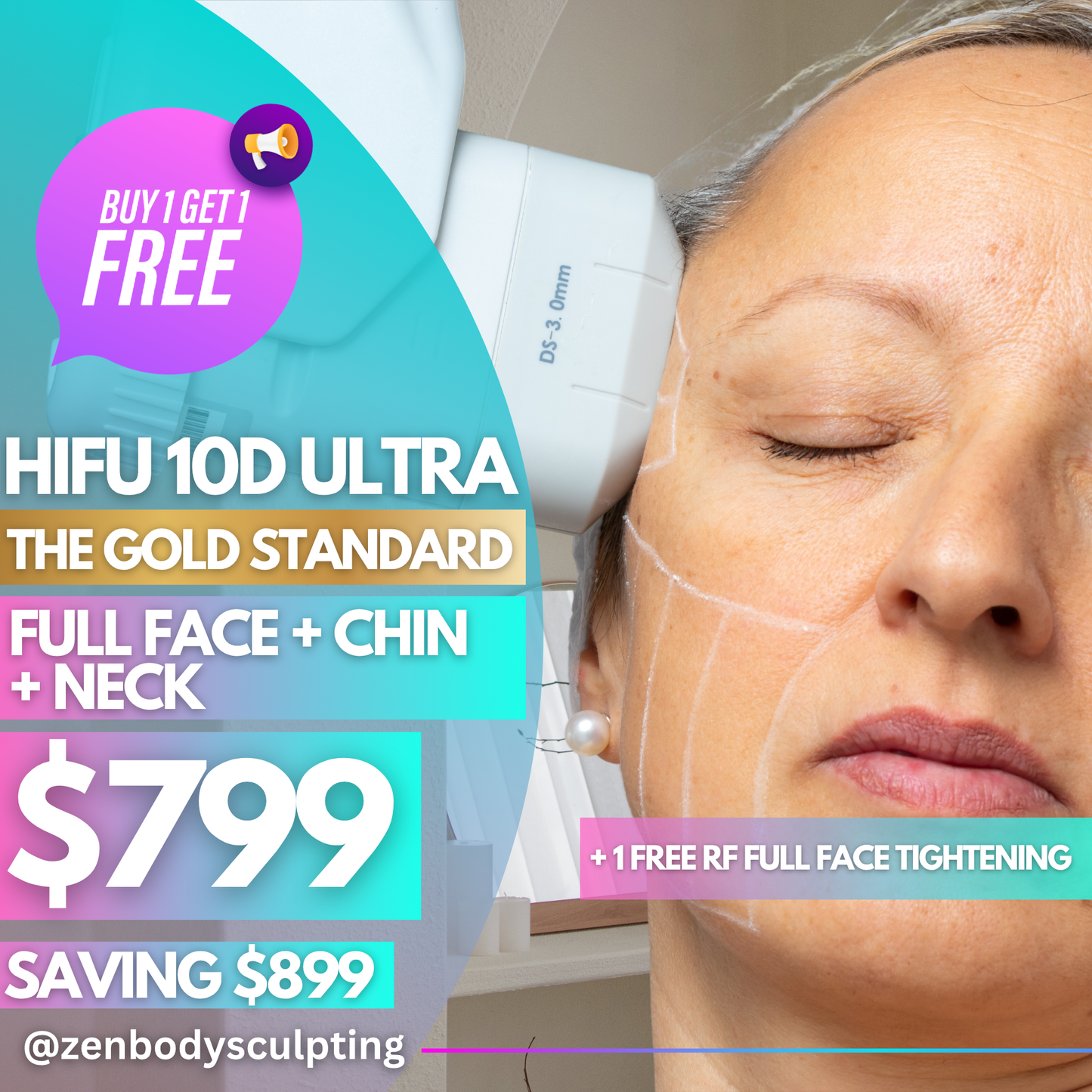 HIFU 10D ULTRA - 2 SESSIONS OF FULL FACE + CHIN + NECK