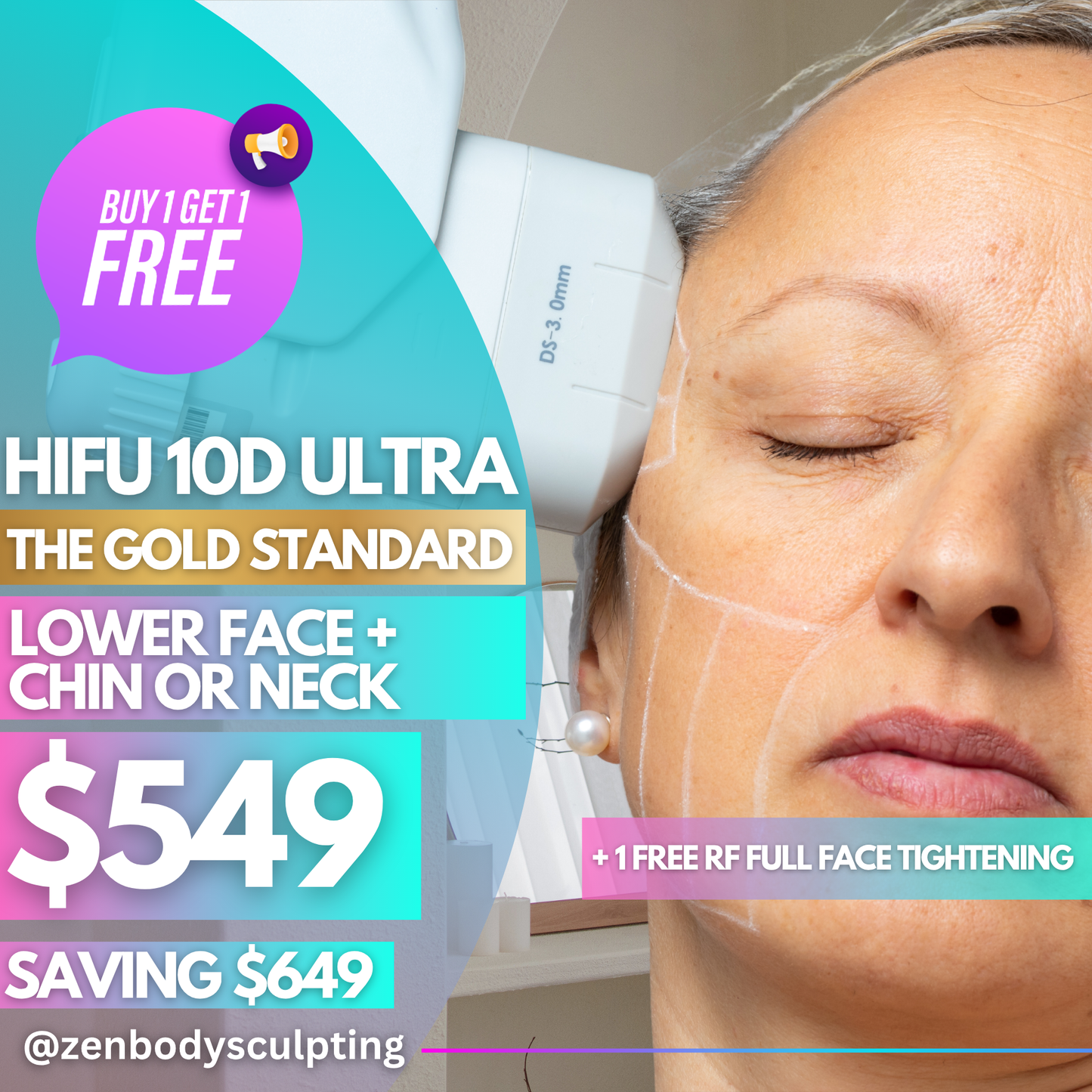 HIFU 10D ULTRA - 2 SESSIONS OF LOWER FACE + CHIN OR NECK