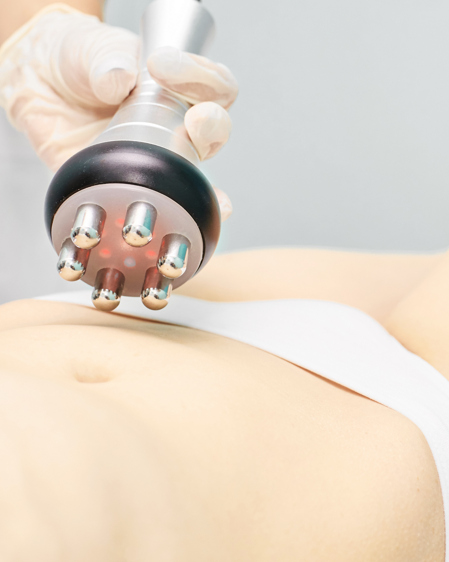 RF Skin Tightening how it work 
