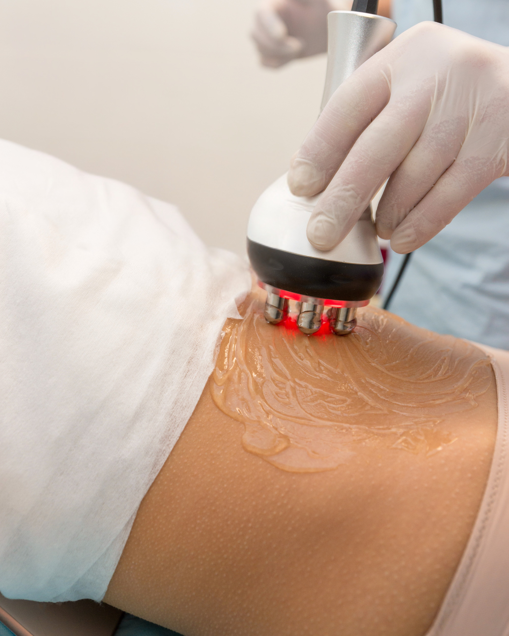 RF Skin Tightening