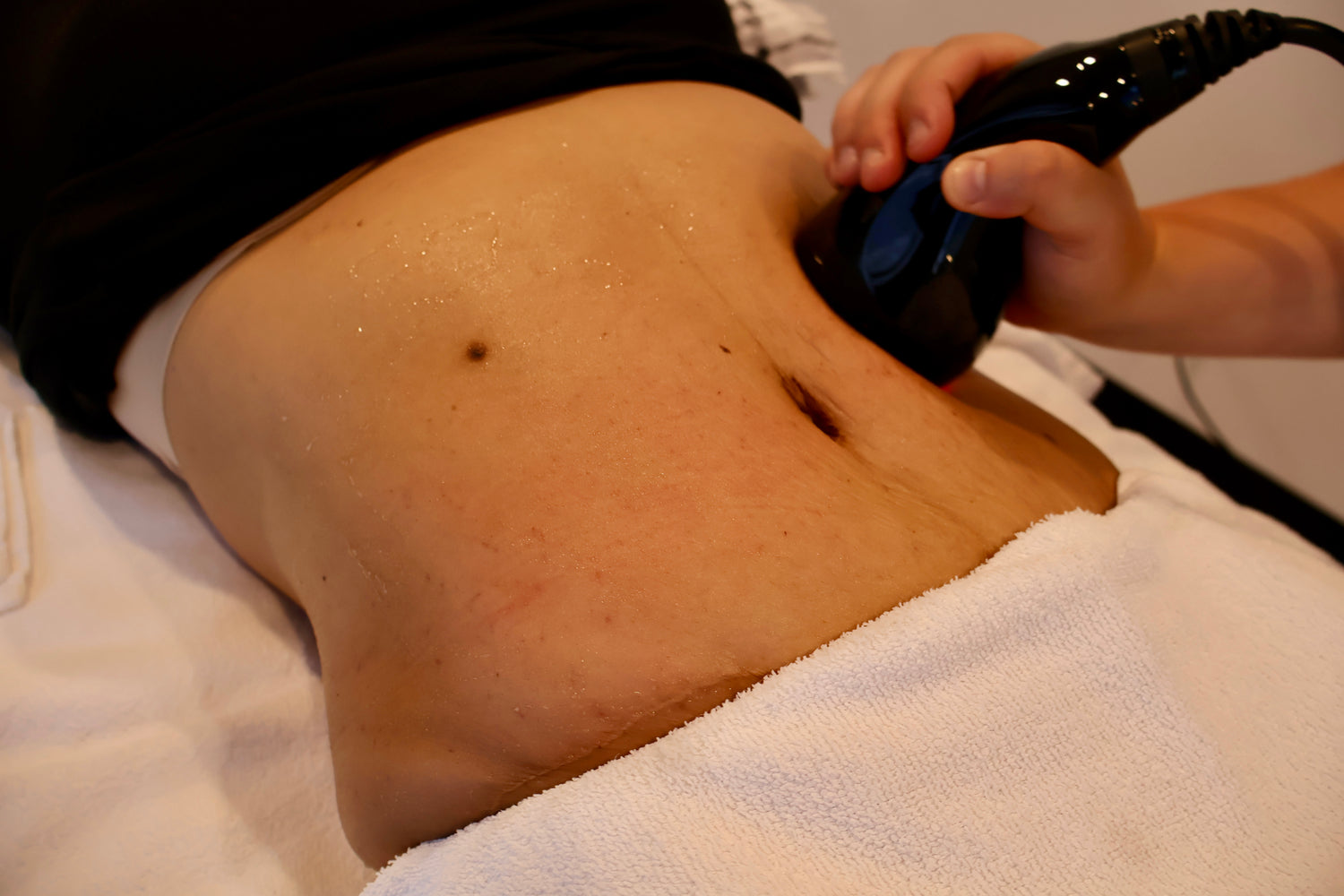Fat Cavitation how it work